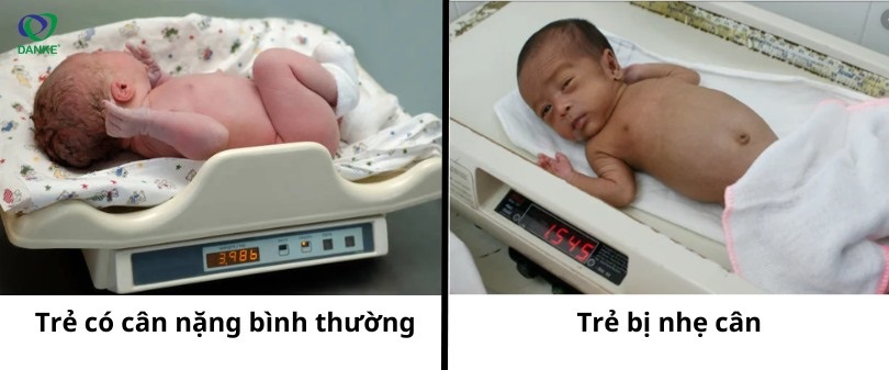 So sánh trẻ có cân năng bình thường và trẻ bị nhẹ cân 