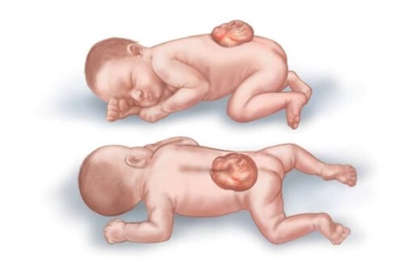 dị tật thai nhi nguyên nhân, dị tật bẩm sinh là gì, phát hiện dị tật thai nhi bằng cách nào, thai bị dị tật phải làm sao, tại sao thai nhi bị dị tật bẩm sinh, siêu âm dị tật thai nhi tuần thứ bao nhiêu, dấu hiệu thai nhi bị dị tật